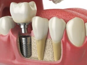 סוגי השתלות שיניים- כל מה שצריך לדעת על ההשתלה