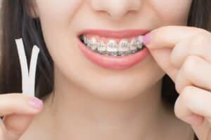 Applying orthodontic wax on the dental braces. Brackets on the teeth after whitening. Self-ligating