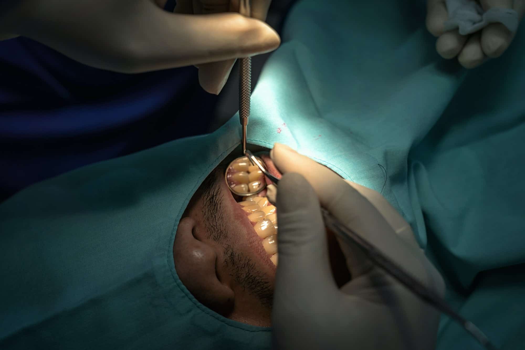 Closeup Dentist and assistant operating for checking and teeth cleaning at dental clinic