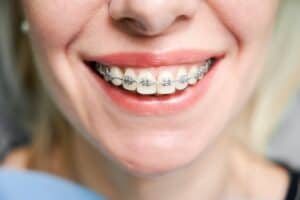 ביטוח יישור שיניים